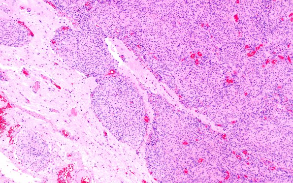 6A3 Meningioma, anaplastic (Case 6) H&E 1