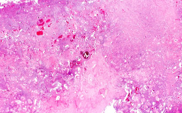 6A4 Meningioma, anaplastic (Case 6) H&E 2X