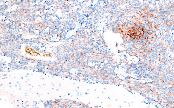 6B Meningioma, anaplastic (Case 6) EMA 2