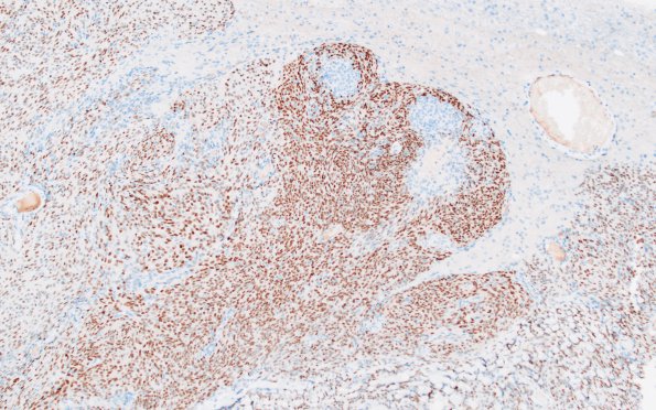 6C Meningioma, anaplastic (Case 6) PR 2