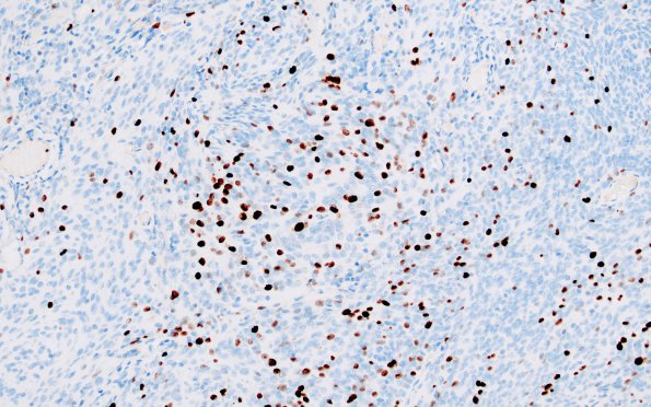 6D Meningioma, anaplastic (Case 6) Ki67 1