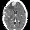 7A Meningioma, anaplastic (Case 7) CTW - Copy