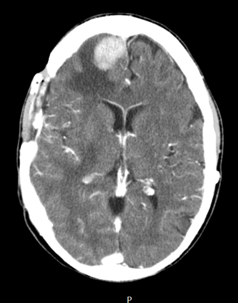 7A Meningioma, anaplastic (Case 7) CTW - Copy