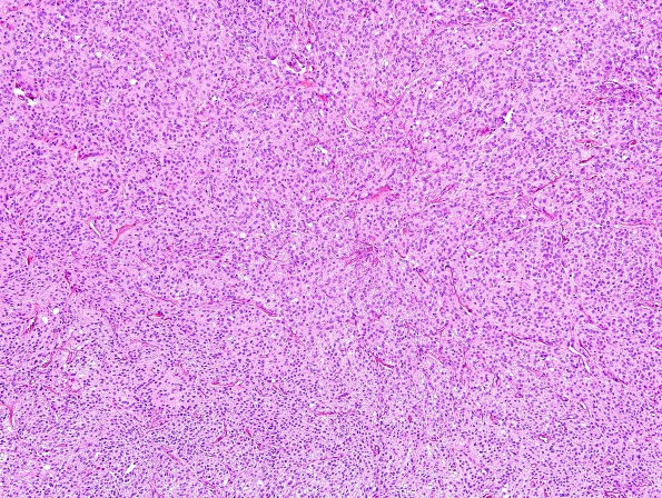 7B1 Meningioma, anaplastic (Case 7) H&E 4.jpg