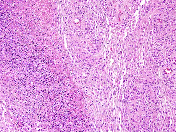 7B2 Meningioma, anaplastic (Case 7) H&E 1.jpg