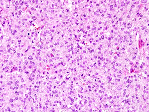 7B3 Meningioma, anaplastic (Case 7) H&E 6.jpg