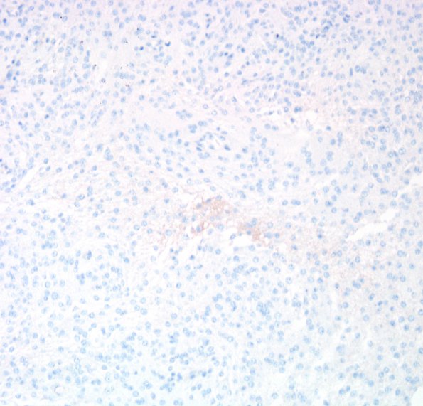 7C Meningioma, anaplastic (Case 7) PR 2.jpg