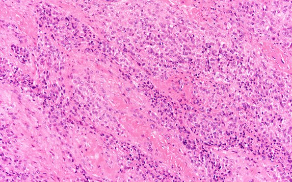 8A1 Meningioma, Anaplastic (Case 8) H&E 20x