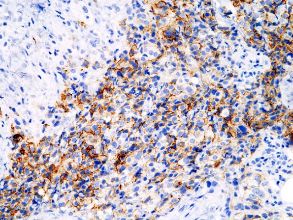 8B1 Meningioma, Anaplastic (Case 8) EMA 1.jpg