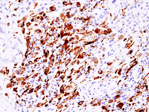 8B2 Meningioma, Anaplastic (Case 8) CK7 2.jpg