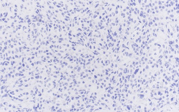 8C Meningioma, Anaplastic (Case 8) PR 40X