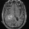 9A1 Meningioma, Anaplastic (Case 9) TRAN 3D T1 - Copy