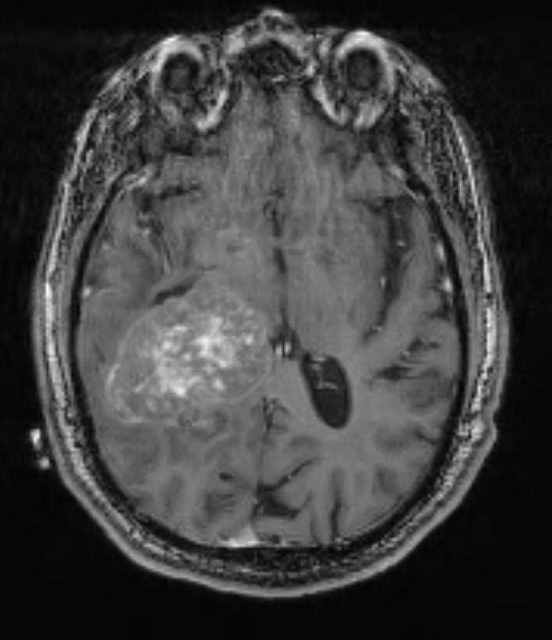 9A1 Meningioma, Anaplastic (Case 9) TRAN 3D T1 - Copy