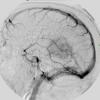 9A2 Meningioma, Anaplastic (Case 9) Angio 1 - Copy