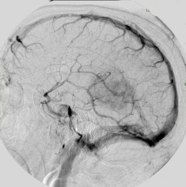 9A2 Meningioma, Anaplastic (Case 9) Angio 1 - Copy