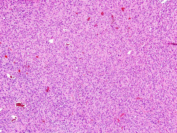 9B1 Meningioma, Anaplastic (Case 9) H&E 2