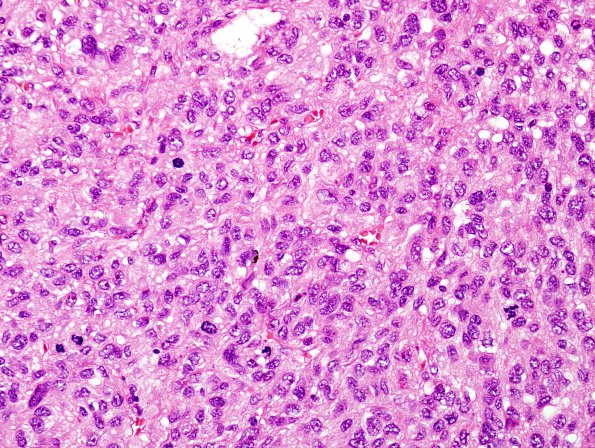 9B2 Meningioma, Anaplastic (Case 9) H&E 4