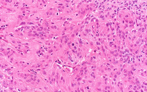 9B3 Meningioma, Anaplastic (Case 9) H&E 40X 3