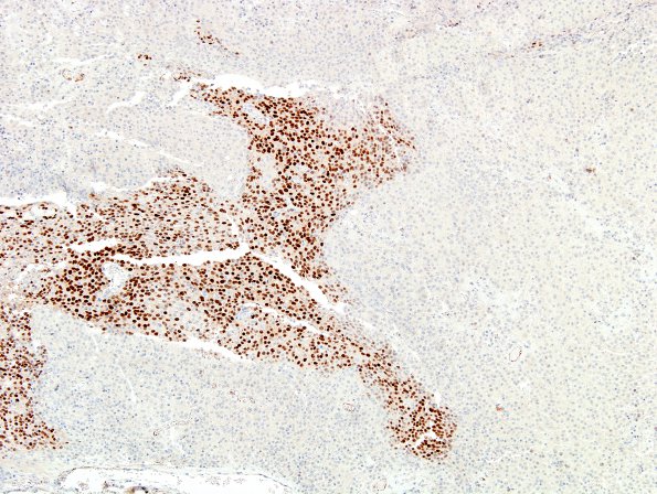 9D Meningioma, Anaplastic (Case 9) PR 2