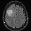 10A1 Meningioma, Micro Angio (Case 10) FLAIR - Copy