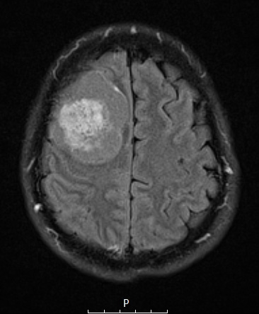 10A1 Meningioma, Micro Angio (Case 10) FLAIR - Copy