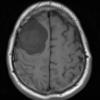 10A2 Meningioma, Micro Angio (Case 10) T1noC - Copy