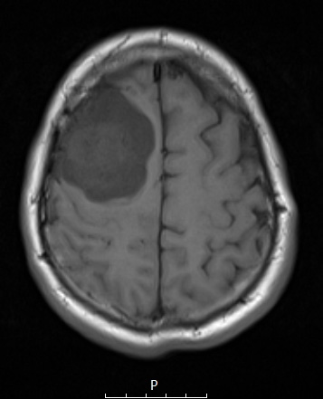 10A2 Meningioma, Micro Angio (Case 10) T1noC - Copy