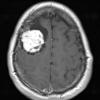 10A3 Meningioma, Micro Angio (Case 10) T1W - Copy