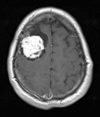 10A3 Meningioma, Micro Angio (Case 10) T1W - Copy