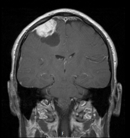 10A4 Meningioma, Micro Angio (Case 10) T1W 2 - Copy