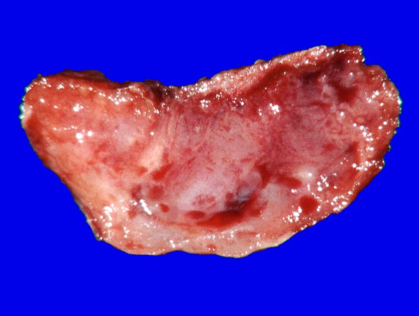 10B Meningioma, micro angio (Case 10) 9