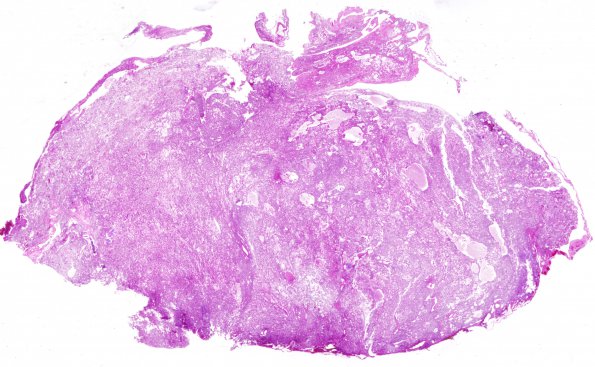 10C1 Meningioma, angiomatous (Case 10) H&E WM