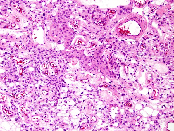 10C2 Meningioma, angiomatous (Case 10) H&E 1