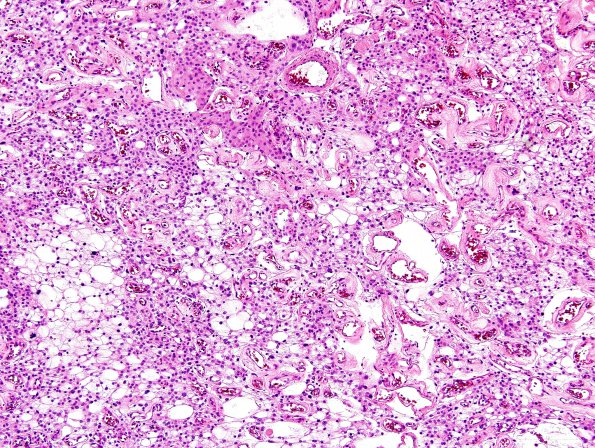 10C3 Meningioma, angiomatous (Case 10) H&E 2