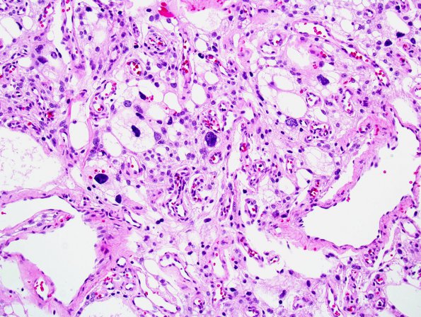 10C4 Meningioma, Micro Angio (Case 10) 1.jpg