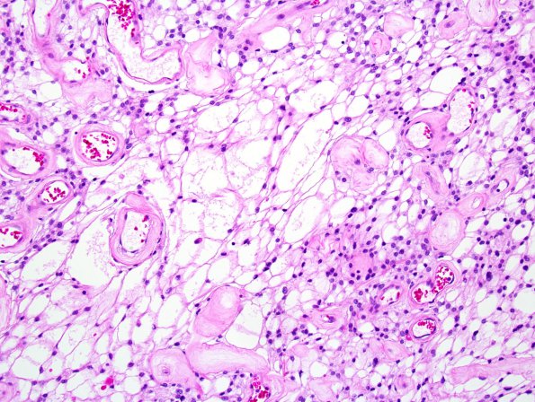 10C5 Meningioma, Micro Angio (Case 10) 3.jpg