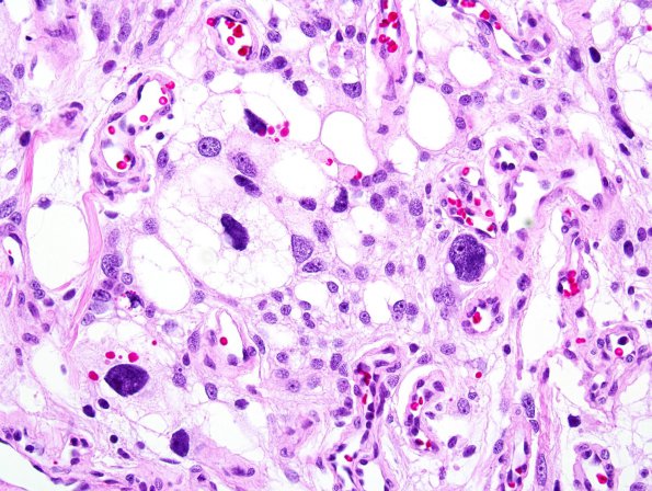 10C6 Meningioma, Micro Angio (Case 10) 2.jpg