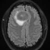 11A1 Meningioma (Case 11) FLAIR - Copy