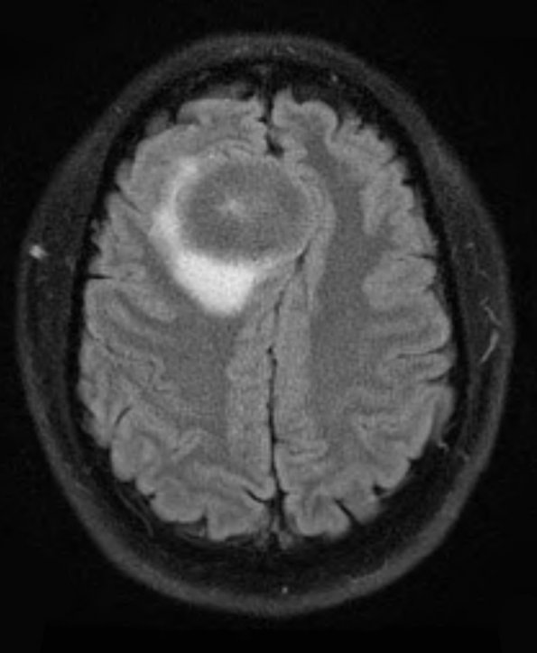 11A1 Meningioma (Case 11) FLAIR - Copy