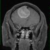 11A2 Meningioma (Case 11) T1W 1 - Copy