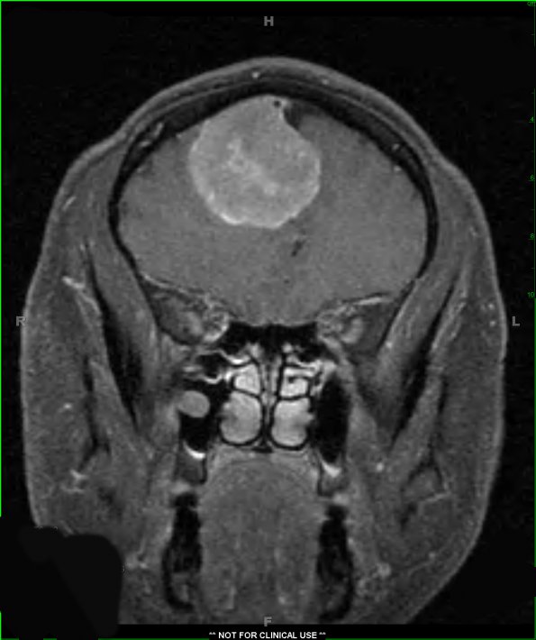 11A2 Meningioma (Case 11) T1W 1 - Copy