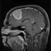 11A3 Meningioma (Case 11) T1W 2 - Copy