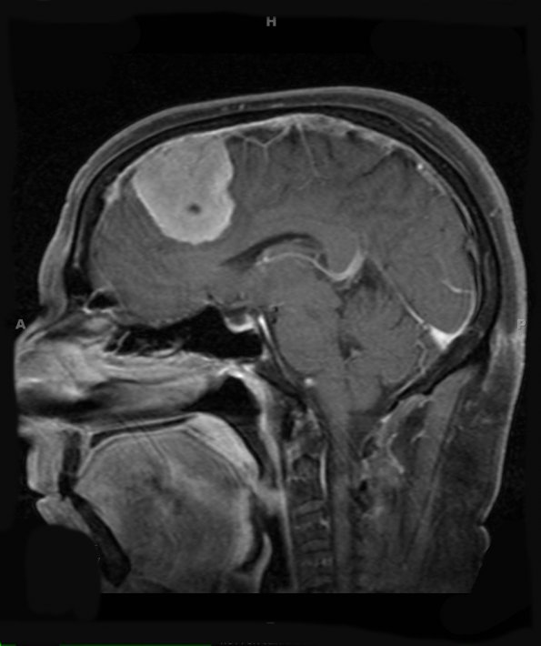 11A3 Meningioma (Case 11) T1W 2 - Copy