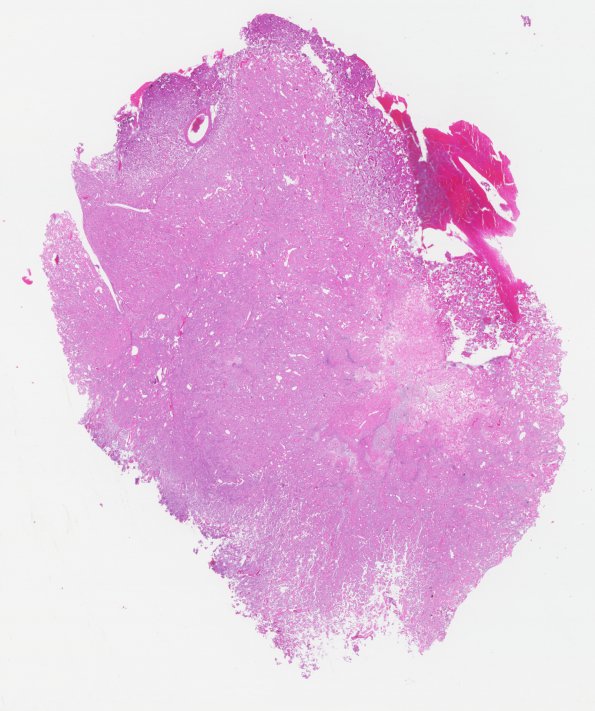 11B1 Meningioma, angiomatous (Case 11) H&E WM