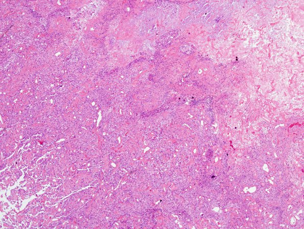 11B2 Meningioma (Case 11) H&E 1