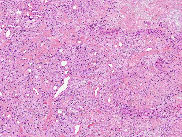 11B3 Meningioma (Case 11) H&E 2