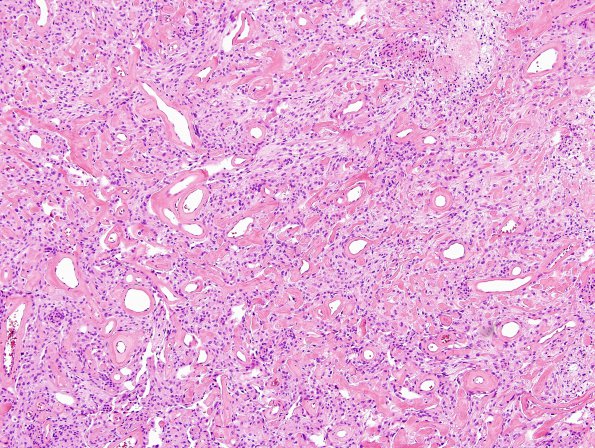 11B4 Meningioma (Case 11) H&E 5