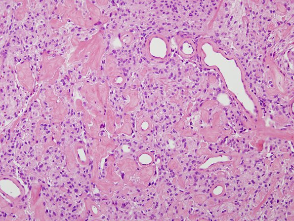 11B5 Meningioma (Case 11) H&E 3