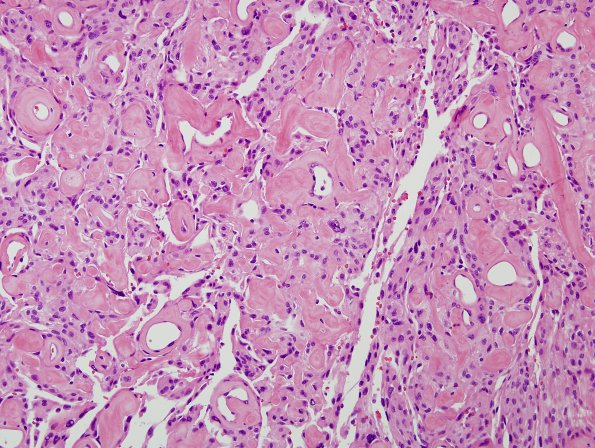 11B6 Meningioma (Case 11) H&E 4