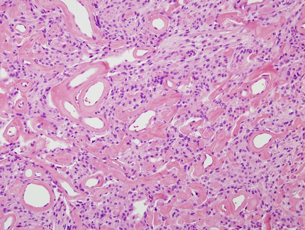 11B7 Meningioma (Case 11) H&E 6